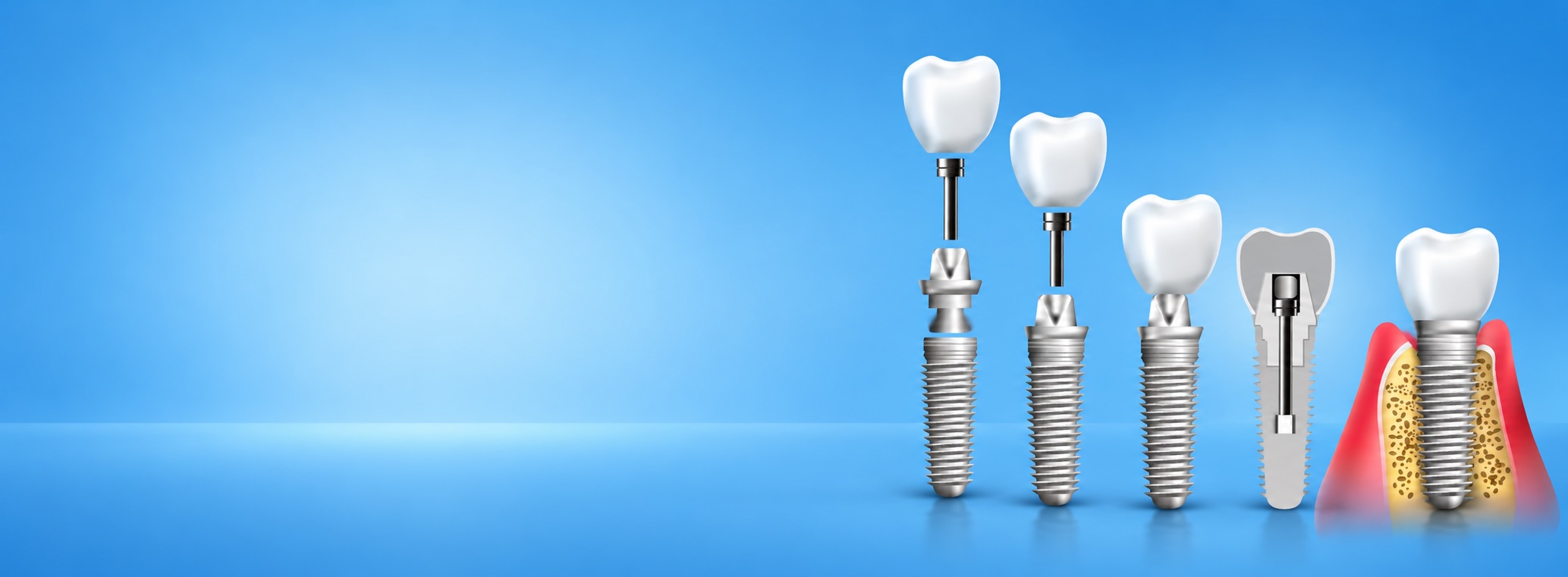 Dental Implant Special : Banner