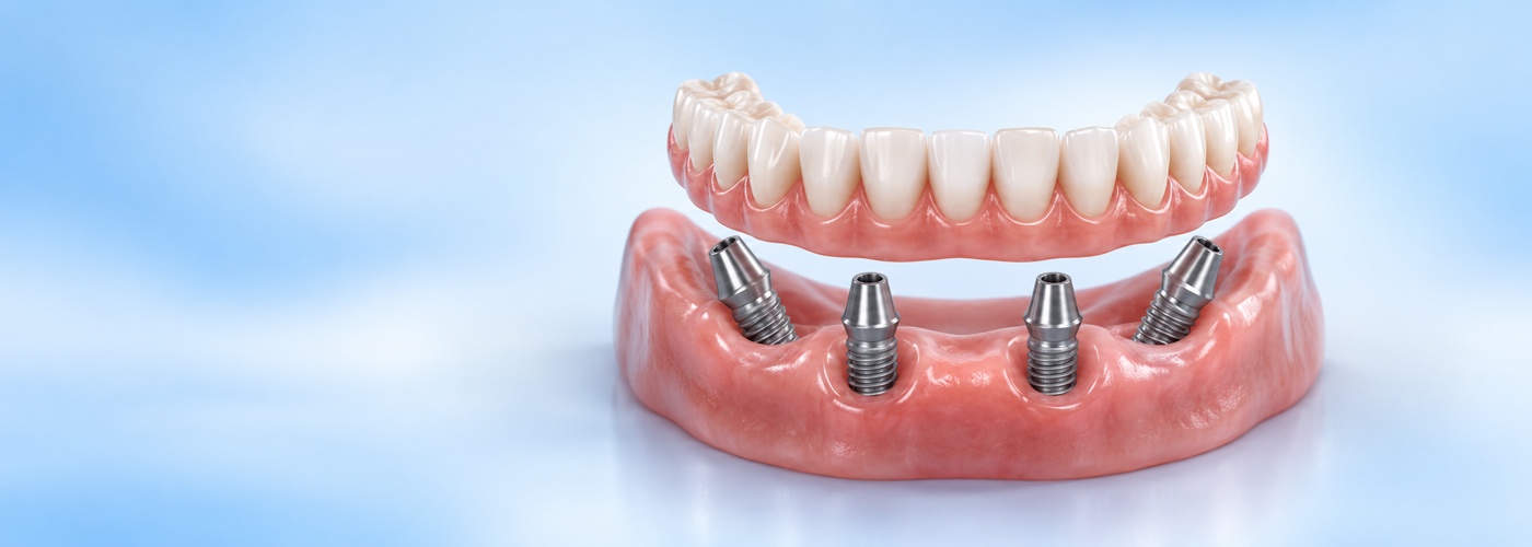 All-on-X Dental Implants in Watertown Center