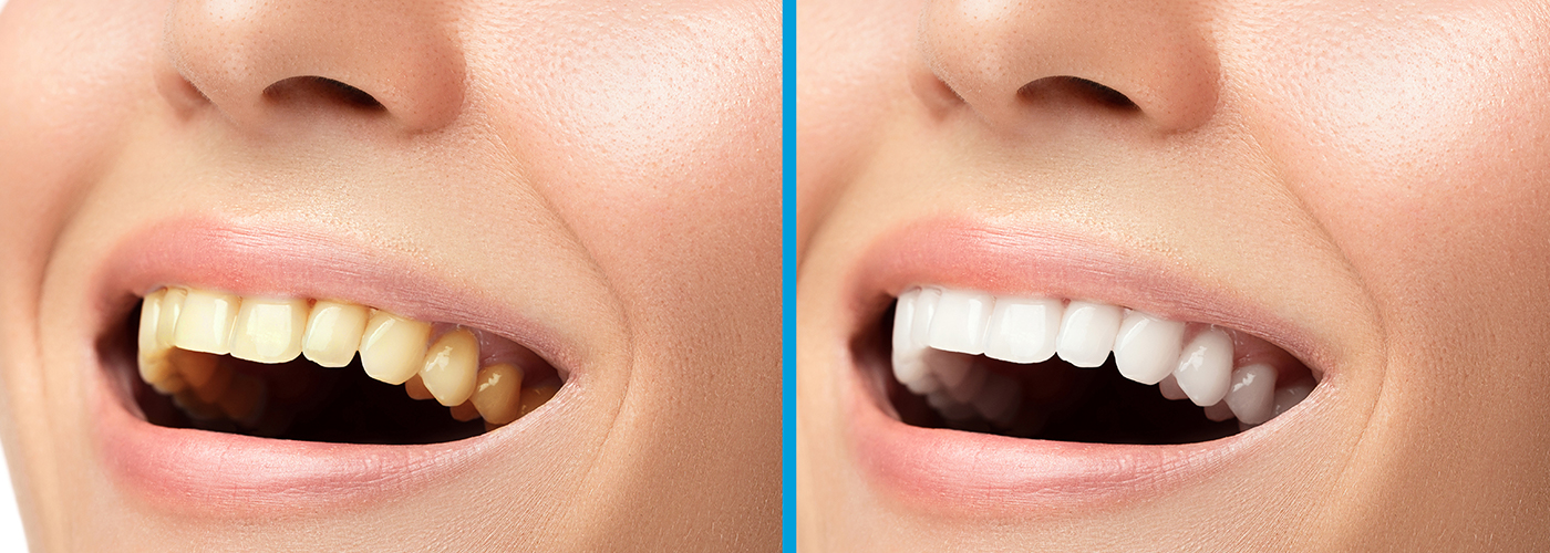 Teeth Whitening in Watertown, MA